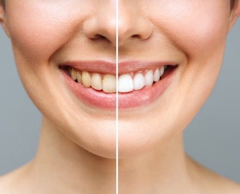 woman-teeth-before-after-whitening-white-background-dental-clinic-patient-image-symbolizes